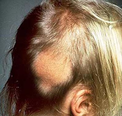 El tratamiento de la alopecia el resultado de la foto